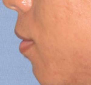 Lip Reduction