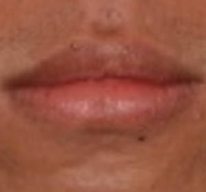 Lip Reduction