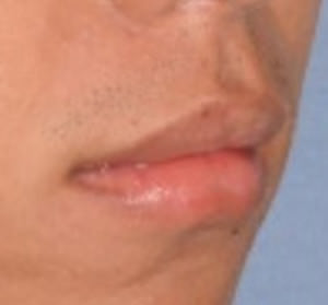 Lip Reduction