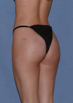 Butt Gluteal Implants