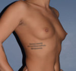 Breast Augmentation Implants