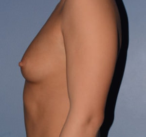 Breast Augmentation Implants