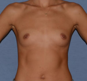 Breast Augmentation Implants