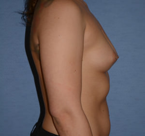 Breast Augmentation Implants