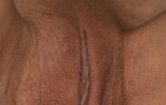 Clitoral Hood Reduction