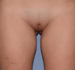 Labiaplasty