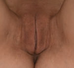 Labiaplasty