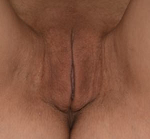 Labiaplasty
