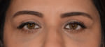 Eyelid Lift