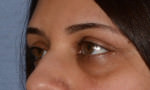 Eyelid Lift