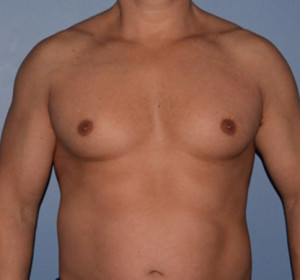 Male Breast Reduction Gynecomastia