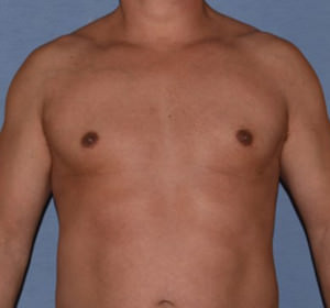 Male Breast Reduction Gynecomastia