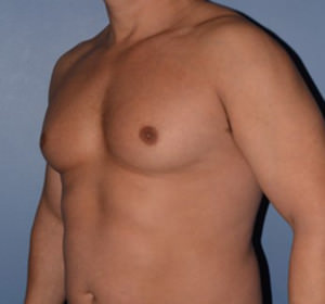 Male Breast Reduction Gynecomastia