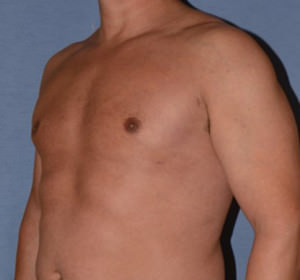 Male Breast Reduction Gynecomastia