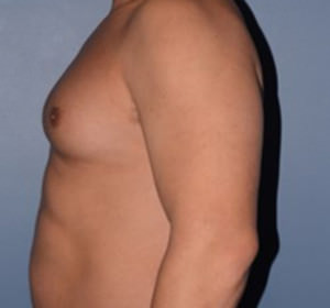 Male Breast Reduction Gynecomastia