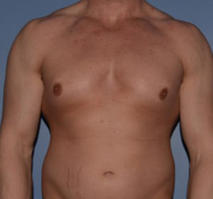 Male Breast Reduction Gynecomastia