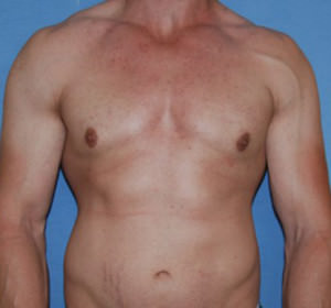 Male Breast Reduction Gynecomastia