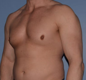 Male Breast Reduction Gynecomastia