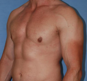 Male Breast Reduction Gynecomastia