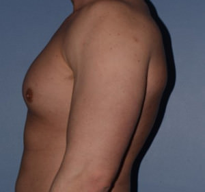 Male Breast Reduction Gynecomastia