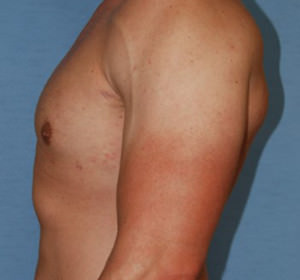 Male Breast Reduction Gynecomastia