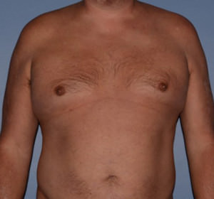 Male Breast Reduction Gynecomastia