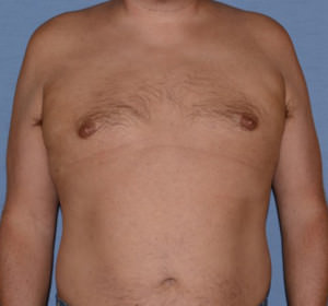 Male Breast Reduction Gynecomastia