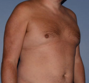 Male Breast Reduction Gynecomastia