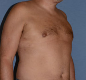 Male Breast Reduction Gynecomastia