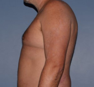 Male Breast Reduction Gynecomastia