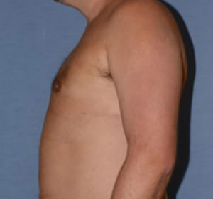 Male Breast Reduction Gynecomastia