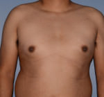 Male Breast Reduction Gynecomastia