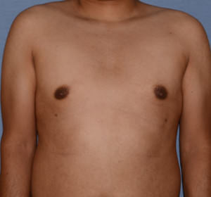 Male Breast Reduction Gynecomastia