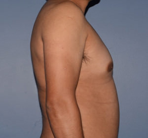 Male Breast Reduction Gynecomastia