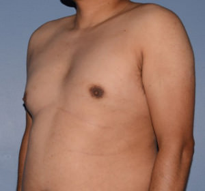 Male Breast Reduction Gynecomastia