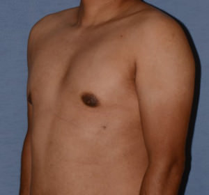 Male Breast Reduction Gynecomastia