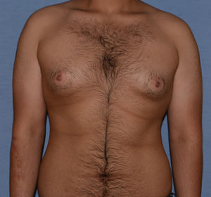 Male Breast Reduction Gynecomastia