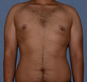 Male Breast Reduction Gynecomastia