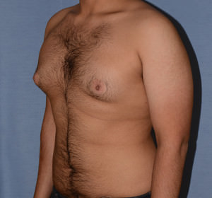 Male Breast Reduction Gynecomastia