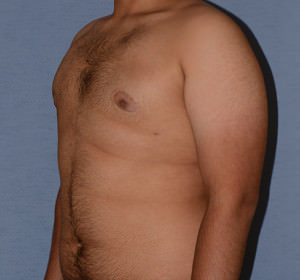 Male Breast Reduction Gynecomastia