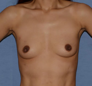 Breast Augmentation Implants