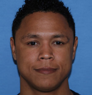 Scar or Mole Correction