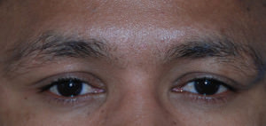 Scar or Mole Correction