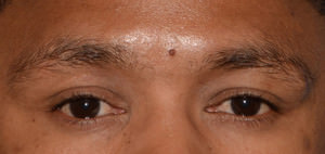 Scar or Mole Correction