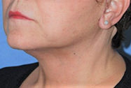 Necklift