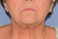 Necklift