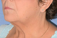 Necklift