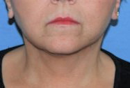 Necklift
