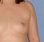 Breast Correction