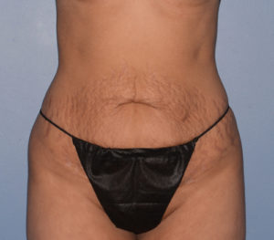 Tummy Tuck